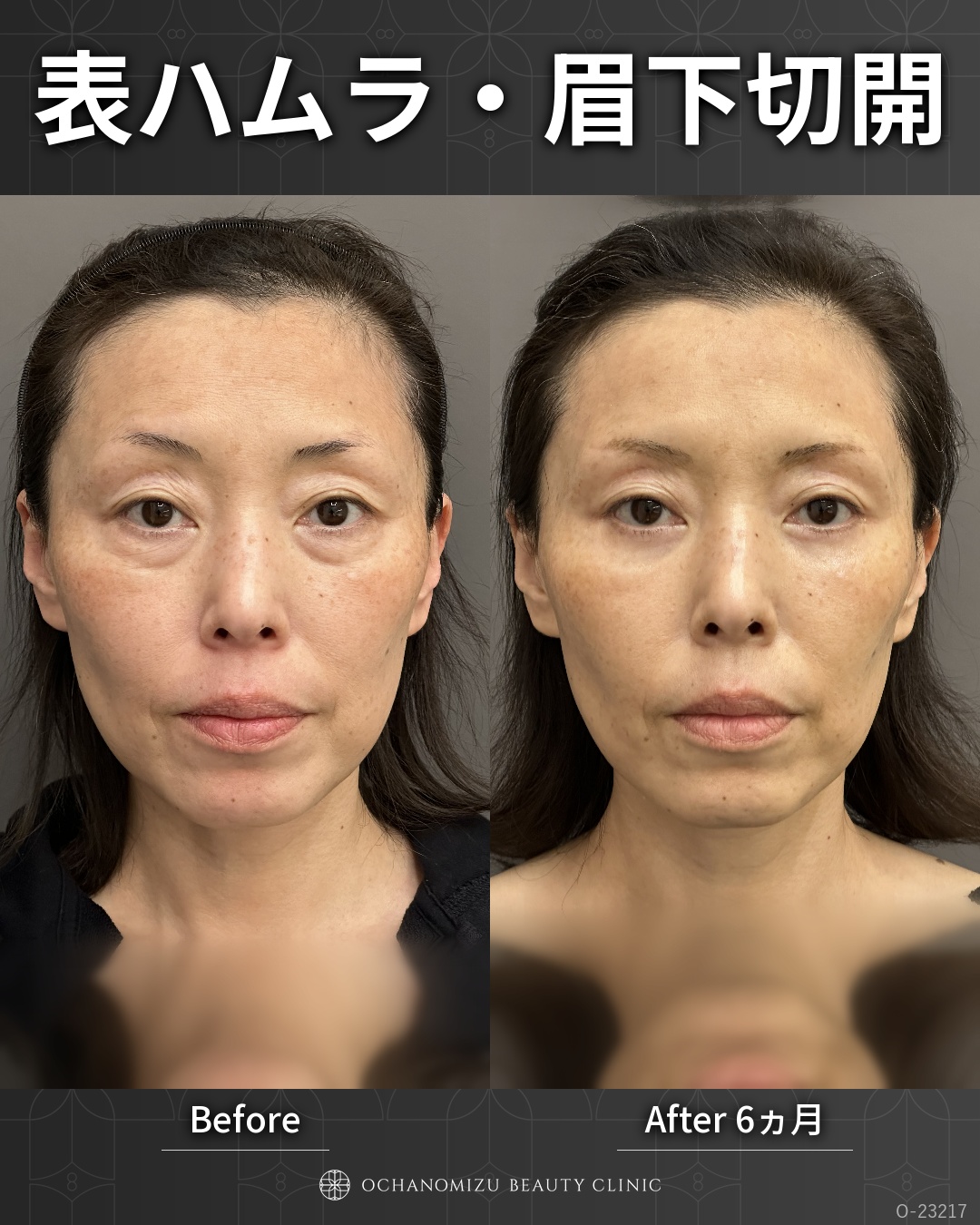 表ハムラ＋眉下切開