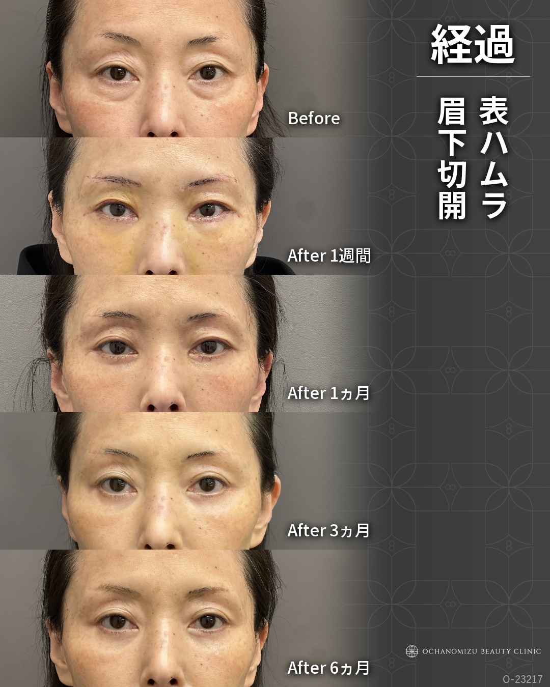 表ハムラ＋眉下切開