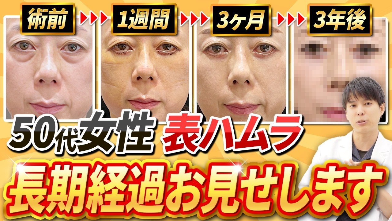 クマ取り手術の長期経過｜3年後もきれいな目元を保つ治療の選び方