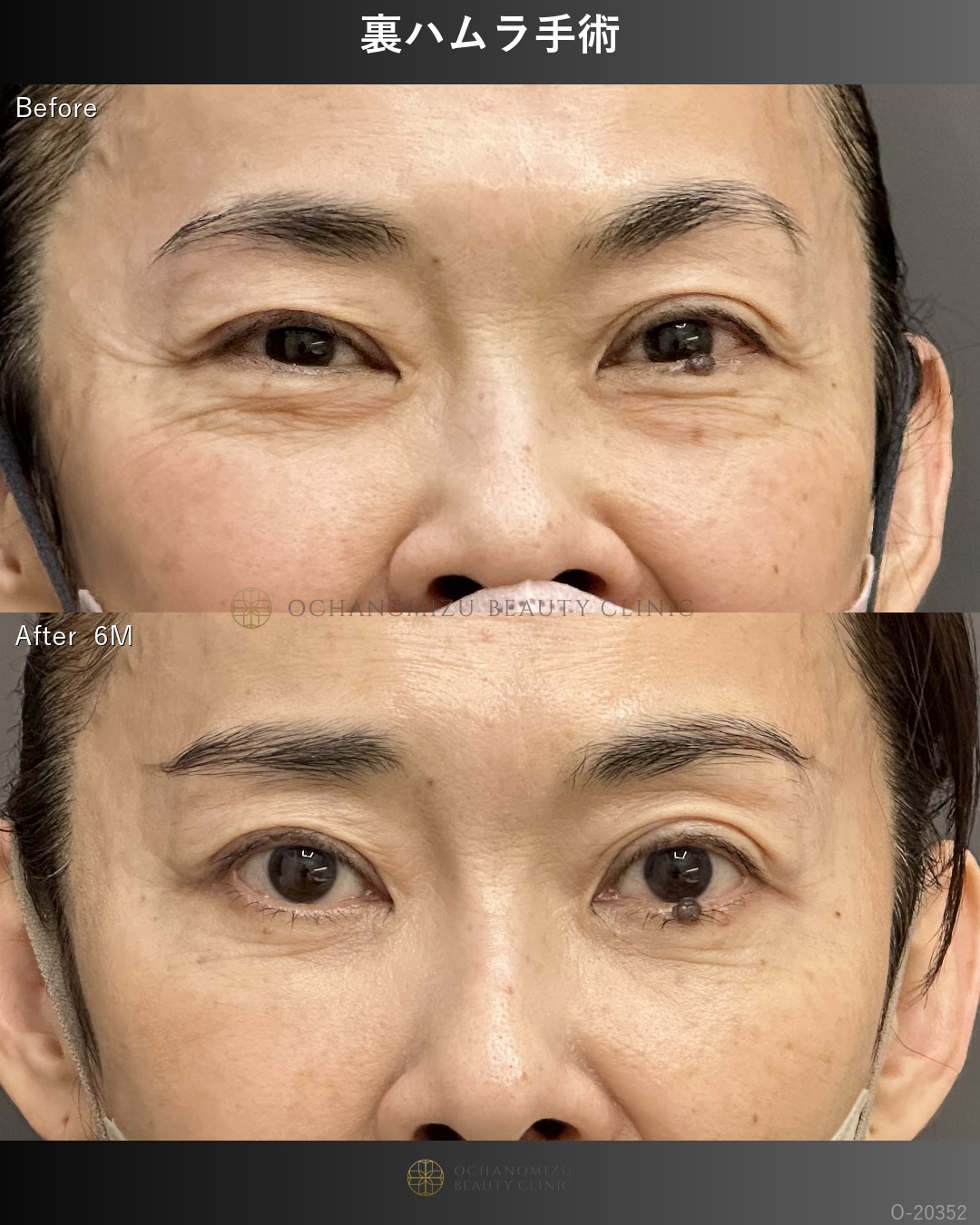 裏ハムラ