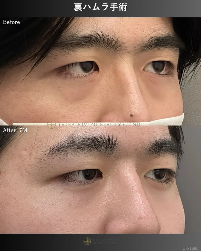 裏ハムラ