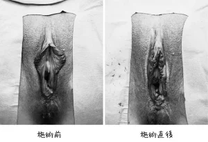 小陰唇縮小術